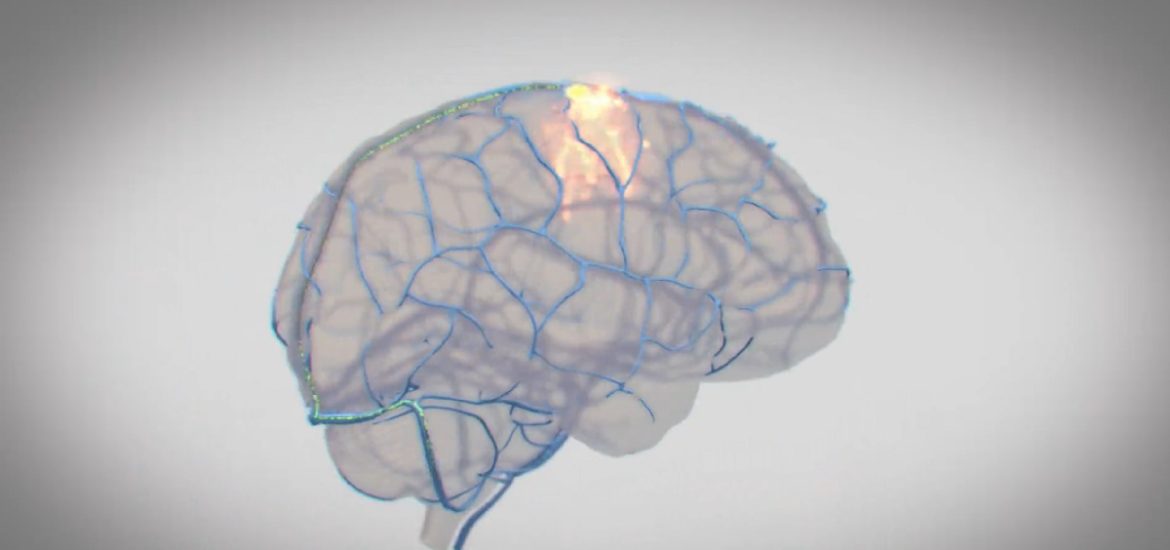 Synchron, konkurent Neuralinku, chce mozgovÃ½m implantÃ¡tom lieÄiÅ¥ Parkinsona